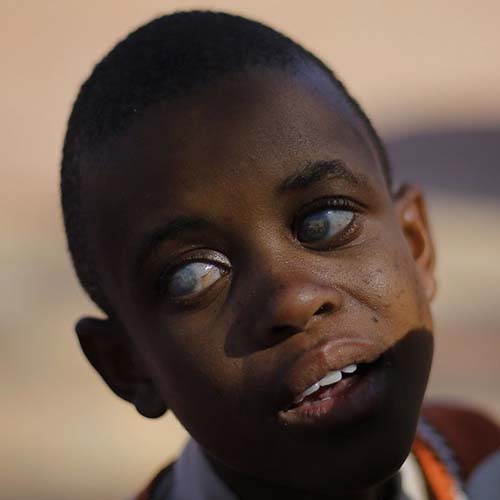 Support a Visually Impaired Child Today